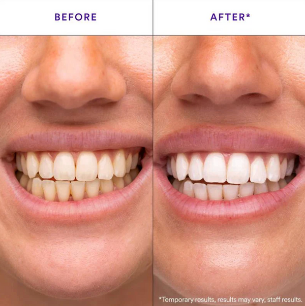 Teeth Whitening Strips