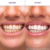 Teeth Whitening Strips